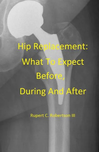 Hip Replacement: What To Expect Before, During and After - Paperback