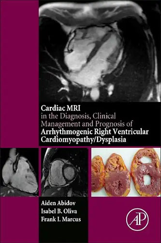 Cardiac MRI in Diagnosis, Clinical Management, and Prognosis of Arrhythmogenic Right Ventricular Cardiomyopathy/Dysplasia - Paperback