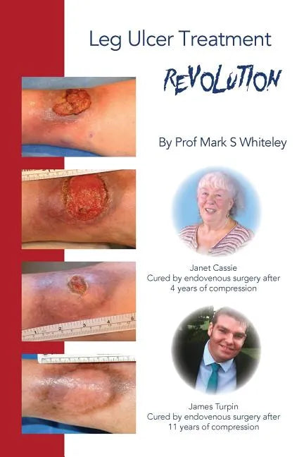Leg Ulcer Treatment Revolution - Paperback