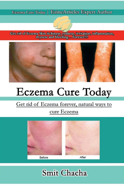 Eczema Cure Today - Get rid of Eczema forever natural ways to cure Eczema - Paperback