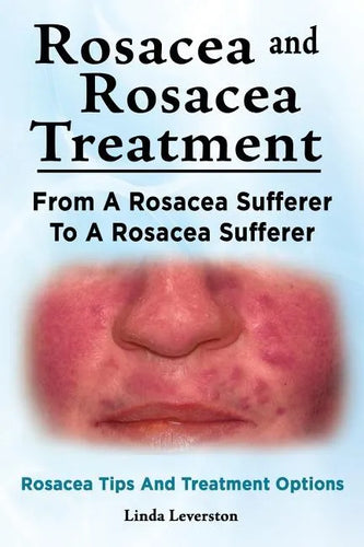 Rosacea and Rosacea Treatment. From A Rosacea Sufferer To A Rosacea Sufferer. Rosacea Tips And Treatment Options - Paperback