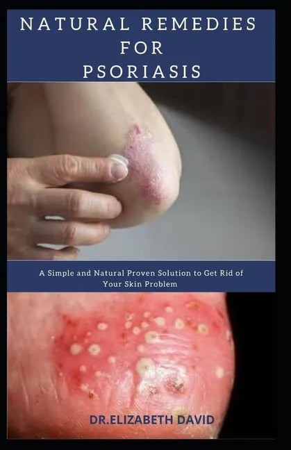 Natural Remedies for Psoriasis: A Simple and Natural Proven Solution to Get Rid of Your Skin Problem: Dermatitis, Eczema, Psoriasis & Rosacea and Othe - Paperback
