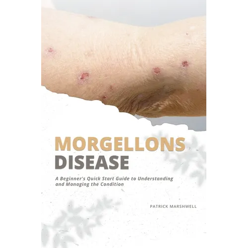 Morgellons Disease: A Beginner's Quick Start Guide to Understanding and Managing the Condition - Paperback