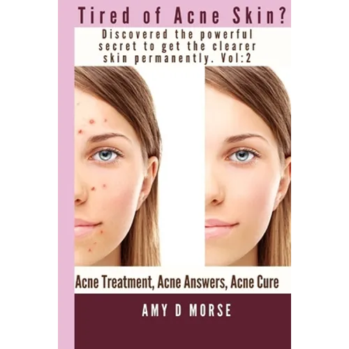 TIRED OF ACNE SKIN? Discover the Powerful Secrets to get Clearer Skin Permanently - Paperback