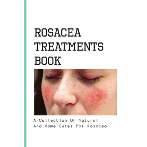 Rosacea Treatments Book- A Collection Of Natural And Home Cures For Rosacea: Rosacea Treatment - Paperback