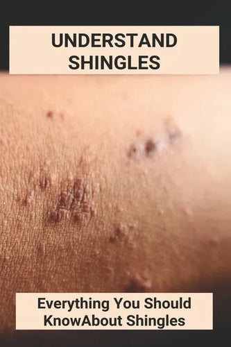 Understand Shingles: Everything You Should Know About Shingles: Shingles Topical Treatment - Paperback