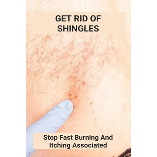 Get Rid Of Shingles: Stop Fast Burning And Itching Associated: Shingles On Face Treatment - Paperback