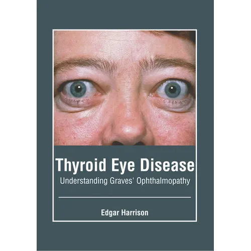 Thyroid Eye Disease: Understanding Graves' Ophthalmopathy - Hardcover