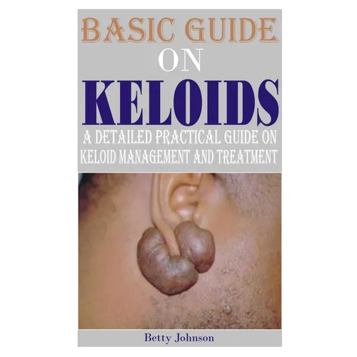 Basic Guide on Keloids: A detailed practical guide on keloid management and treatment - Paperback
