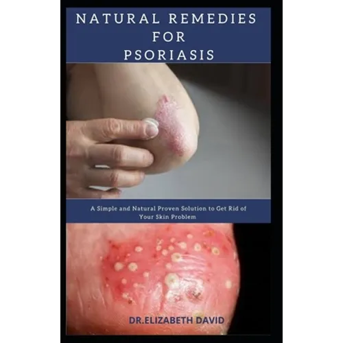 Natural Remedies for Psoriasis: A Simple and Natural Proven Solution to Get Rid of Your Skin Problem: Dermatitis, Eczema, Psoriasis & Rosacea and Othe - Paperback